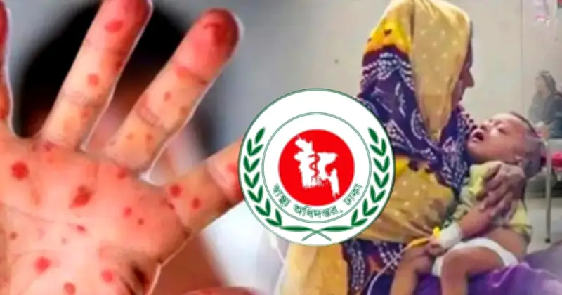 হামের আক্রান্তে ২৪ ঘণ্টায় ৩ শিশুর মৃত্যু