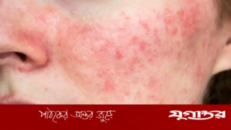 গরমে ত্বকের র্যাশ দূর করুন ঘরোয়া প্যাক দিয়ে