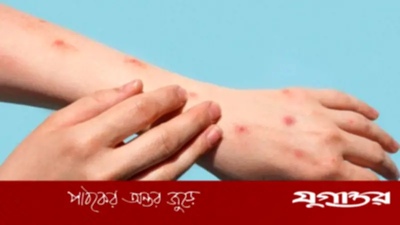চিকেন পক্স হলে করণীয়: কী খাবেন, কী সাবধানতা নেবেন