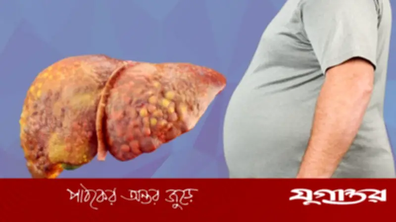 ওজন না কমার পেছনে লিভারের গোপন রোগ ফ্যাটি লিভার