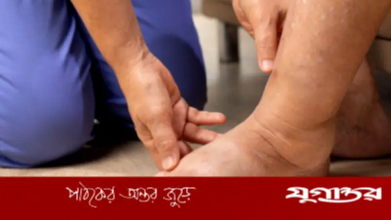শরীরে পানি জমার কারণ ও সতর্কতা: ইডিমা সম্পর্কে বিস্তারিত