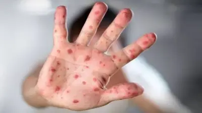হামের মতো উপসর্গে আরও পাঁচ শিশুর মৃত্যু, মৃতের সংখ্যা ৬৪৮