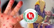 হামের আক্রান্তে ২৪ ঘণ্টায় ৩ শিশুর মৃত্যু