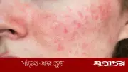 গরমে ত্বকের র্যাশ দূর করুন ঘরোয়া প্যাক দিয়ে