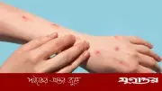 চিকেন পক্স হলে করণীয়: কী খাবেন, কী সাবধানতা নেবেন