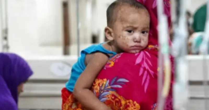 হামের উপসর্গে ২৪ ঘণ্টায় আরও ৩ শিশুর মৃত্যু, মোট ৬৪৮
