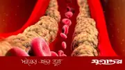 কোলেস্টেরল সামান্য বেশি হলে কী করবেন? বিশেষজ্ঞদের পরামর্শ